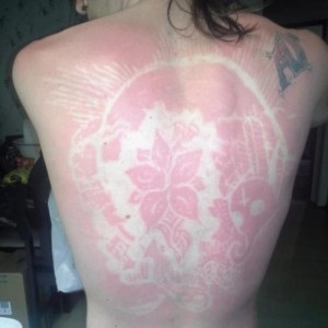 sunburn-art-2